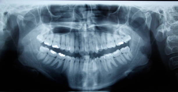 istock mouth dental x-ray 1219058416