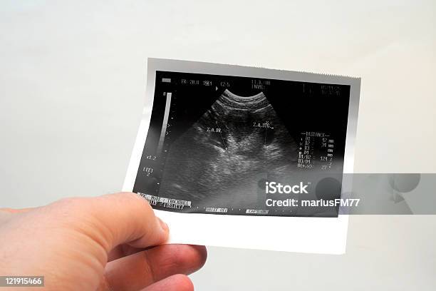 Eierstock Sonogram 2 Stockfoto und mehr Bilder von Eierstock - Eierstock, Ultraschall-Untersuchung, Analysieren