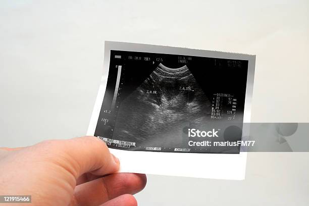 Jajnik Sonogram 2 - zdjęcia stockowe i więcej obrazów Jajnik - Jajnik, Ultradźwięk, Analizować