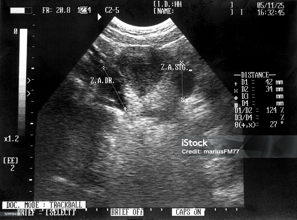 난소 sonogram - 로열티 프리 초음파 스톡 사진