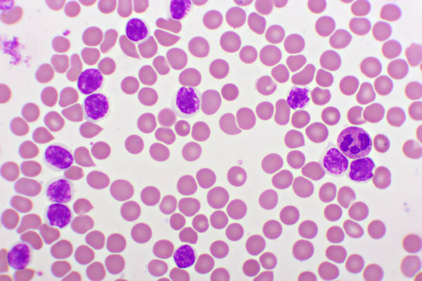 imagen de la leucemia linfocítica aguda o todas las células en el frotis de sangre - blood blood cell cell human cell fotografías e imágenes de stock