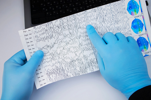 Schedule of electroencephalograms - study of brain currents for signs of epilepsy and pathologies of the nervous system. A neurologist examines an encephalogram of a patient’s brain.