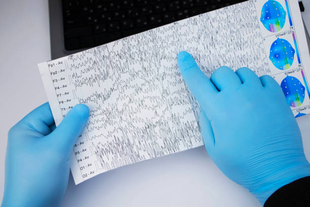 a neurologist examines an encephalogram of a patient’s brain. schedule of electroencephalograms - study of brain currents for signs of epilepsy and pathologies of the nervous system - pulse trace computer monitor eeg equipment imagens e fotografias de stock