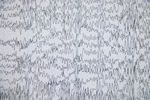 Schedule of electroencephalograms - study of brain currents for signs of epilepsy and pathologies of the nervous system. A neurologist examines an encephalogram of a patient’s brain.