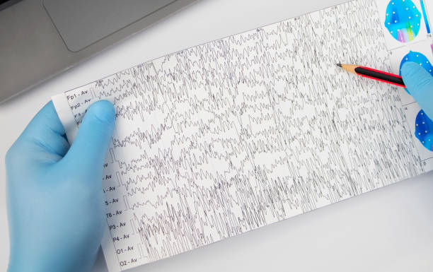 a neurologist examines an encephalogram of a patient’s brain. schedule of electroencephalograms - study of brain currents for signs of epilepsy and pathologies of the nervous system - pulse trace computer monitor eeg equipment imagens e fotografias de stock