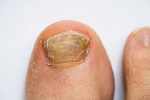 istock Broken Foot Nail And Fungal Infection 1219438009