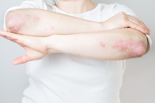 La psoriasis aguda en los codos es una enfermedad dermatológica de la piel autoinmune incurable. Gran erupción roja, inflamada, escamosa en las rodillas. Articulaciones afectadas por artritis psoriásica photo
