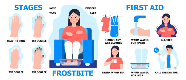 ilustrações de stock, clip art, desenhos animados e ícones de frostbite first aid info-graphic vector. girl is warming hand in water. hypothermia in winter season. fingers, toes, nose damage. stages frostbite. - congelação