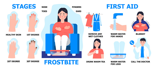 Frostbite first aid info-graphic vector. Girl is warming hand in water. Hypothermia in winter season. Fingers, toes, nose damage. stages of frostbite.