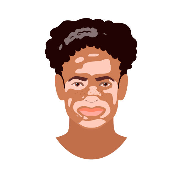 Beautiful young African man face with Vitiligo disorder texture. Skin condition that causes loss of melanin. Сute boy heads isolated on white background. Stock vector illustration in flat style Beautiful young African man face with Vitiligo disorder texture. Skin condition that causes loss of melanin. Сute boy heads isolated on white background. Stock vector illustration in flat style. vitiligo stock illustrations