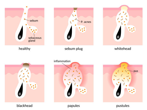 skin layer of acne formation process. types of acne. Healthy skin, sebum plug, whitehead, blackhead, Papules, and Pustules.skin care concept Types of acne pimples. Open comedones, closed comedones, inflammatory acne, cystic acne. Isolated on whwite background epidermal cell stock illustrations