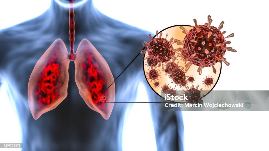 Photo libre de droit de Le Coronavirus Attaque Les Poumons Humains Et Provoque Une Pneumonie Infection Pulmonaire Covid19 Vcov 2019 Microscope Virus De Près 3d Rendu banque d'images et plus d'images libres