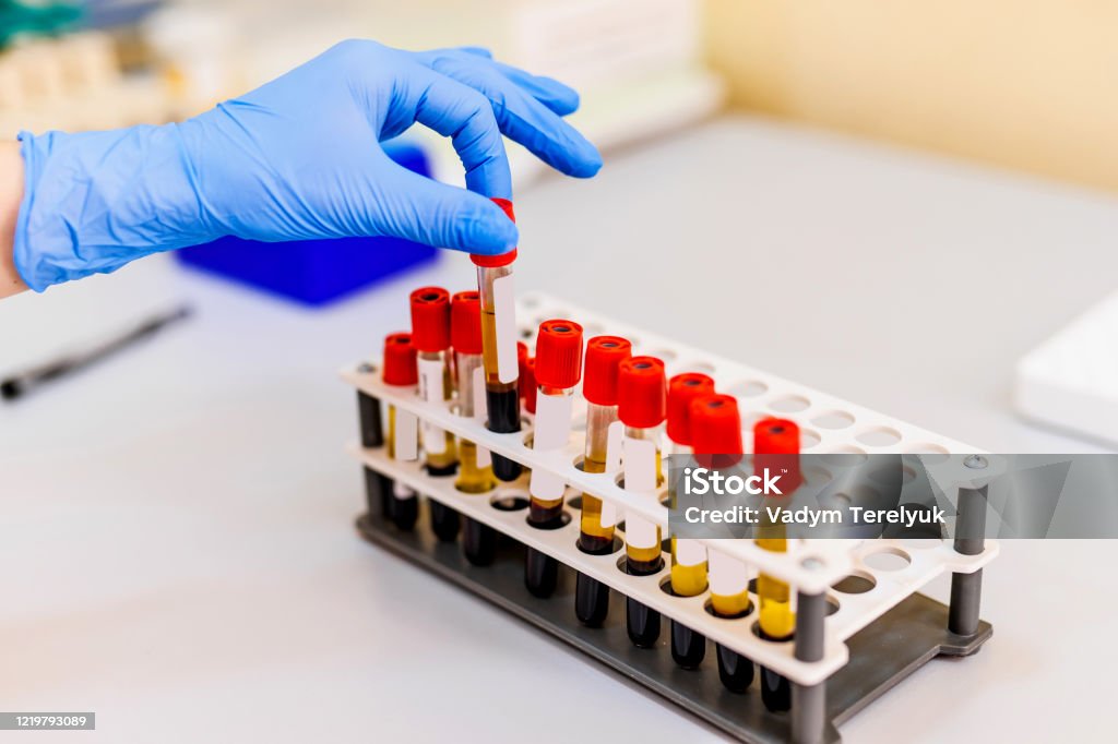 Blood samples for research in microtubes. Blood samples for research in microtubes. Testing in laboratory. Chemical research. Prevention. Pneumonia diagnosing. COVID-19 and coronavirus identification. Pandemic Blood Test Stock Photo