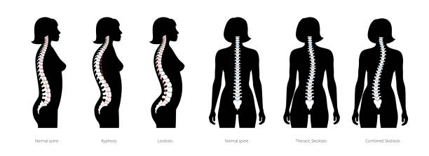 ilustraciones, imágenes clip art, dibujos animados e iconos de stock de ilustración vectorial plana de deformidad espinal - sacrum