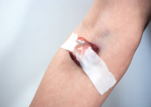 arm bruise von iv drip - iv bruise stock-fotos und bilder