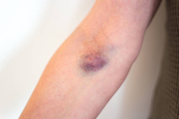 arm bruise von iv drip - iv bruise stock-fotos und bilder