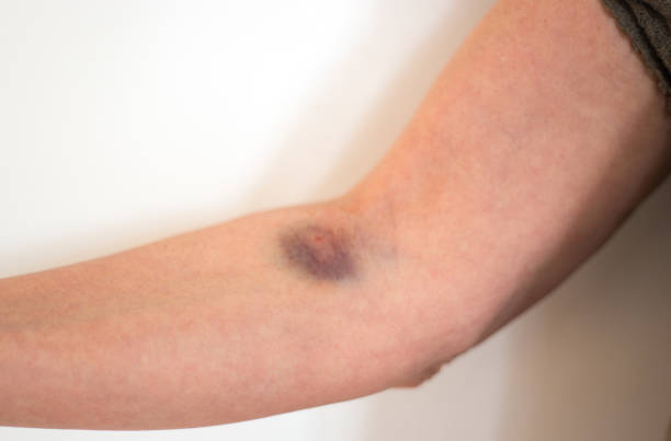 arm bruise von iv drip - iv bruise stock-fotos und bilder