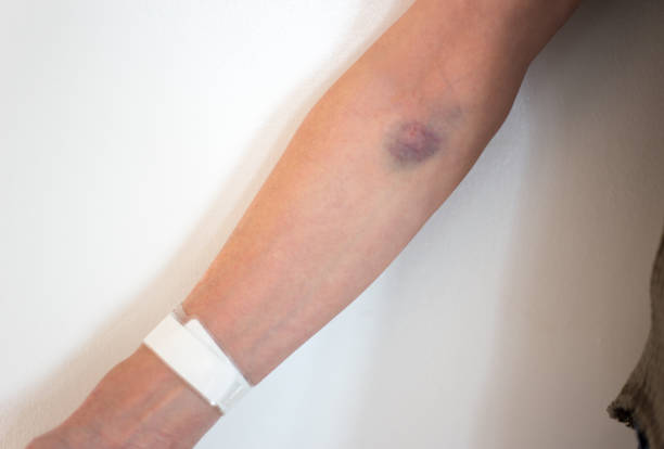 arm bruise von iv drip - iv bruise stock-fotos und bilder