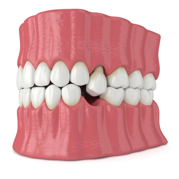 istock 3d render of jaw with protruding tooth revealing root 1219972477