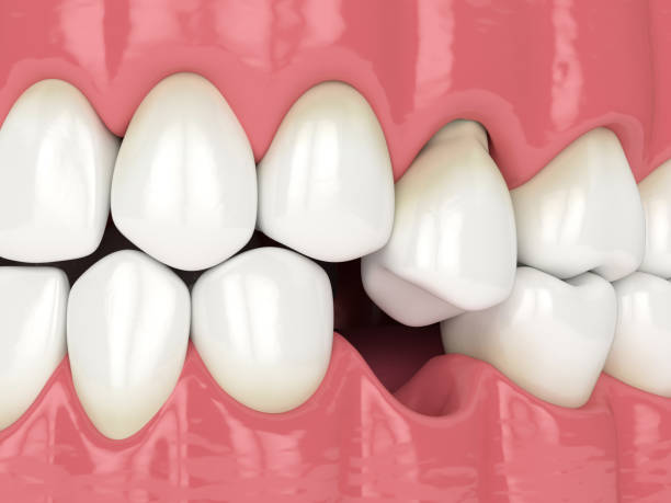 istock 3d render of jaw with protruding tooth revealing root 1219972478