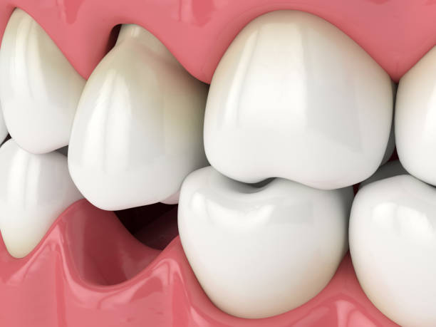istock 3d render of jaw with protruding tooth revealing root 1219972480