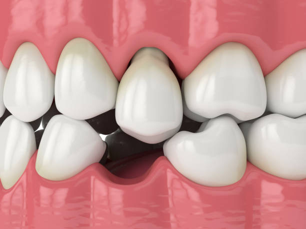 istock 3d render of jaw with protruding tooth revealing root 1219972483