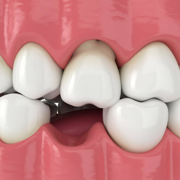istock 3d render of jaw with protruding tooth revealing root 1219972495
