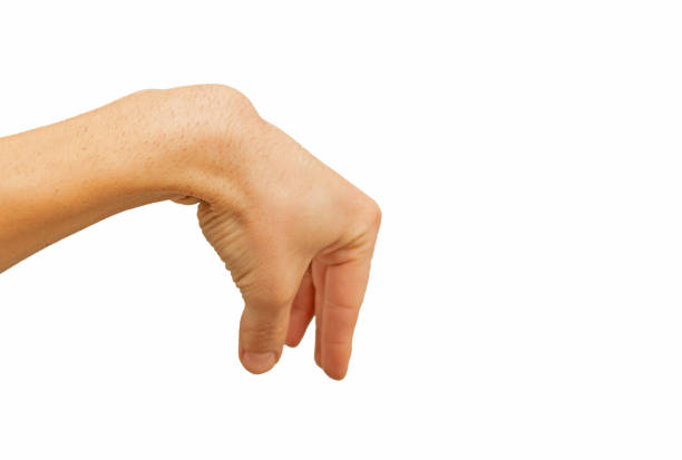 ganglion cysta v zápěstí izolované na bílém pozadí - ganglion - stock snímky, obrázky a fotky