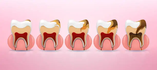 Vector illustration of Placement steps of tooth caries structure  in realistic style. Stain, enamel caries, dentil, pulpitis, periodontitis. Gingiva .Vector illustration 3d.