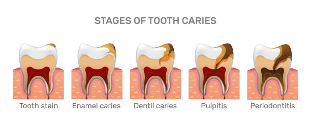 zahnkariesstruktur und vollständige platzierungsschritte in realistischem stil. flecken, emaillekaries, dentil, pulpitis, parodontitis. gingiva. vektor-illustration 3d. - sweet tooth in a row stock-grafiken, -clipart, -cartoons und -symbole