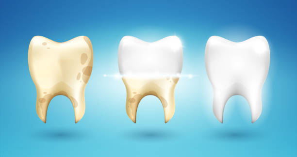 ilustrações de stock, clip art, desenhos animados e ícones de tooth dental brushing in 3d style. stages of calculus and caries removal. process of teeth whitening. stomatology dentistry. vector realism illustration. - equal opportunity flash
