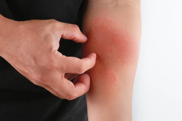 istock Cropped Hand With Skin Disease Against White Background 1220132597