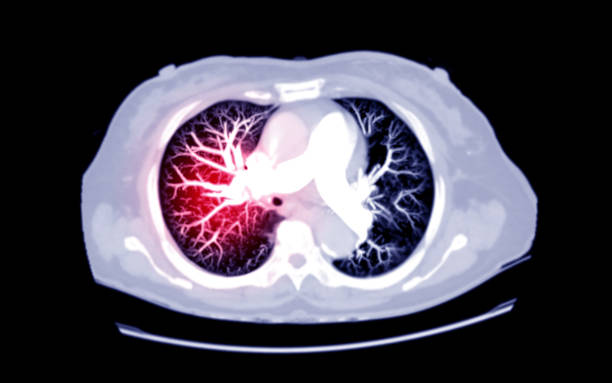 Selective Focus of CT Chest AXIAL MIP view for diagnostic Pulmonary embolism (PE) , lung cancer and covid-19. . Selective Focus of CT Chest AXIAL MIP view for diagnostic Pulmonary embolism ( PE )  , lung cancer and covid-19. . pulmonary artery stock pictures, royalty-free photos & images