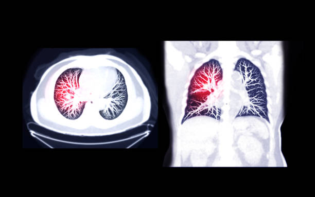 Compare  CT Chest AXIAL and Coronal MIP view for diagnostic Pulmonary embolism (PE) , lung cancer and covid-19. Compare  CT Chest AXIAL and Coronal MIP view for diagnostic Pulmonary embolism (PE) , lung cancer and covid-19. pulmonary artery stock pictures, royalty-free photos & images