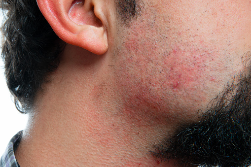 Close-up portrait of a Irritation after shaving on the neck of a man. Horizontal composition. Studio shot.