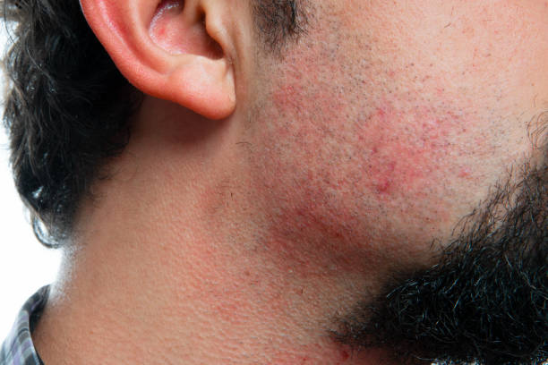 Close-up portrait of a Irritation after shaving on the neck of a man stock photo