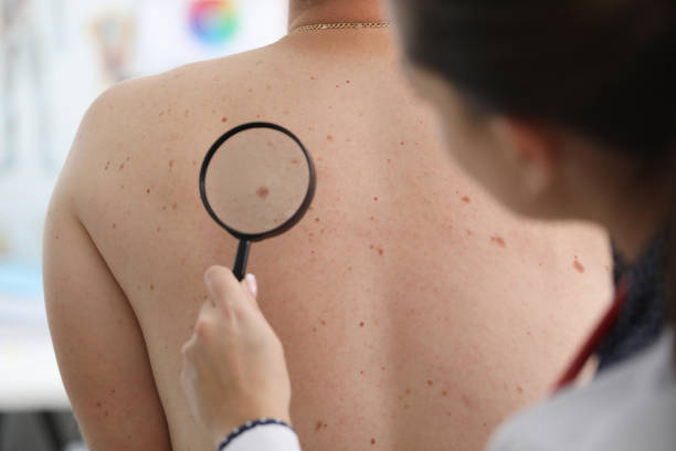 istock Doctor looks through magnifying glass mole patient 1220314848