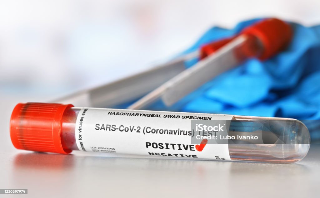 Coronavirus test concept - vial sample tube with cotton swab, red checkmark next to word positive, blurred vials and blue nitrile gloves background. (Sticker is own design with dummy data) Coronavirus Stock Photo