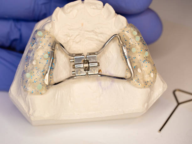 Hyrax braces wear on patient teeth gypsum model. Hyrax braces wear on patient teeth gypsum model.  Dentist check exact setting before putting it on the patient upper palate. hyrax stock pictures, royalty-free photos & images