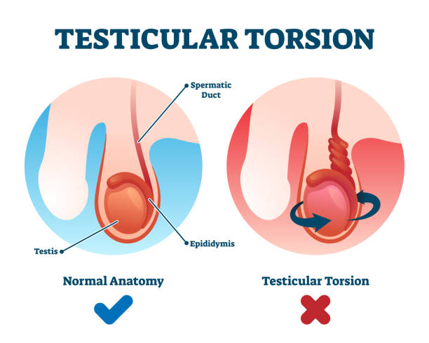 Testicular torsion vector illustration. Labeled spermatic cord twist scheme Testicular torsion vector illustration. Labeled spermatic cord twist diagnosis scheme. Compared educational normal and abnormal anatomy. Male illness and painful bladder health problem disease diagram Testicular Torsion stock illustrations