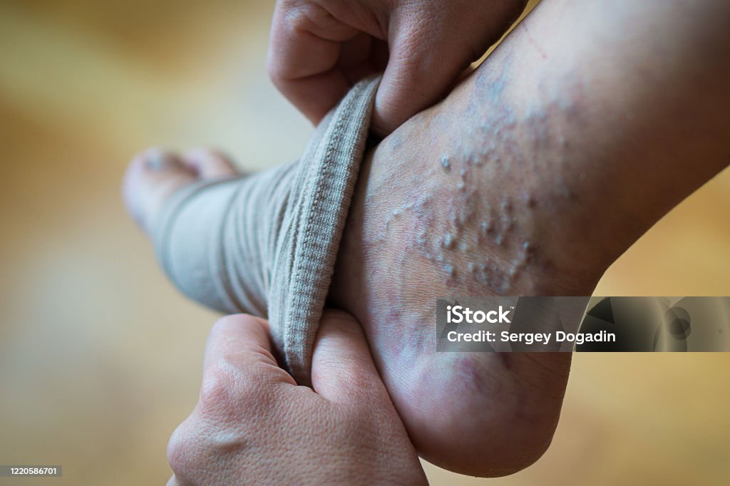 a woman puts a compression stocking on her leg with varicose veins. Varicose veins prevention, Compression tights, relief for tired legs. Beautiful long female legs in stockings. a woman puts a compression stocking on her leg with varicose veins. Varicose veins prevention, Compression tights, relief for tired legs. Beautiful long female legs in stockings Physical Pressure Stock Photo