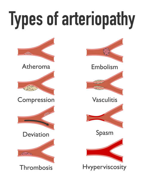 Types of arteriopathy, set of arteries atheroma, embolism, compression, vasculitis, deviation, spasm, thrombosis, hyperviscosity medicine icons Types of arteriopathy, set of arteries atheroma, embolism, compression, vasculitis, deviation, spasm, thrombosis, hyperviscosity medicine icons. vector eps 10 number 10 stock illustrations