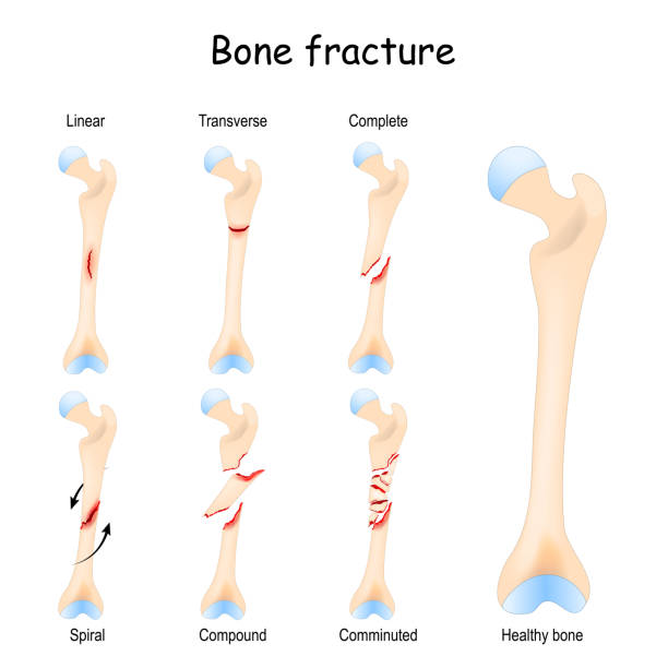 전형적인 뼈 골절 - fracture stock illustrations