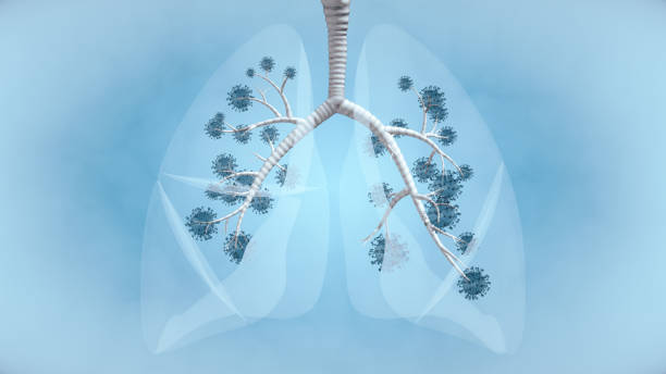 Pandemic Illness in Lung Lung Cancer, Lung Infection, COVID-19, Pandemic - Illness, Coronavirus metastasis photos stock pictures, royalty-free photos & images