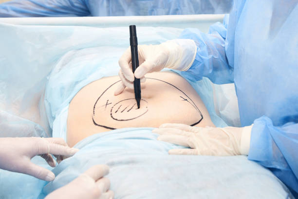 operacji liposukcji. ręce lekarza w pobliżu brzucha - liposuction zdjęcia i obrazy z banku zdjęć