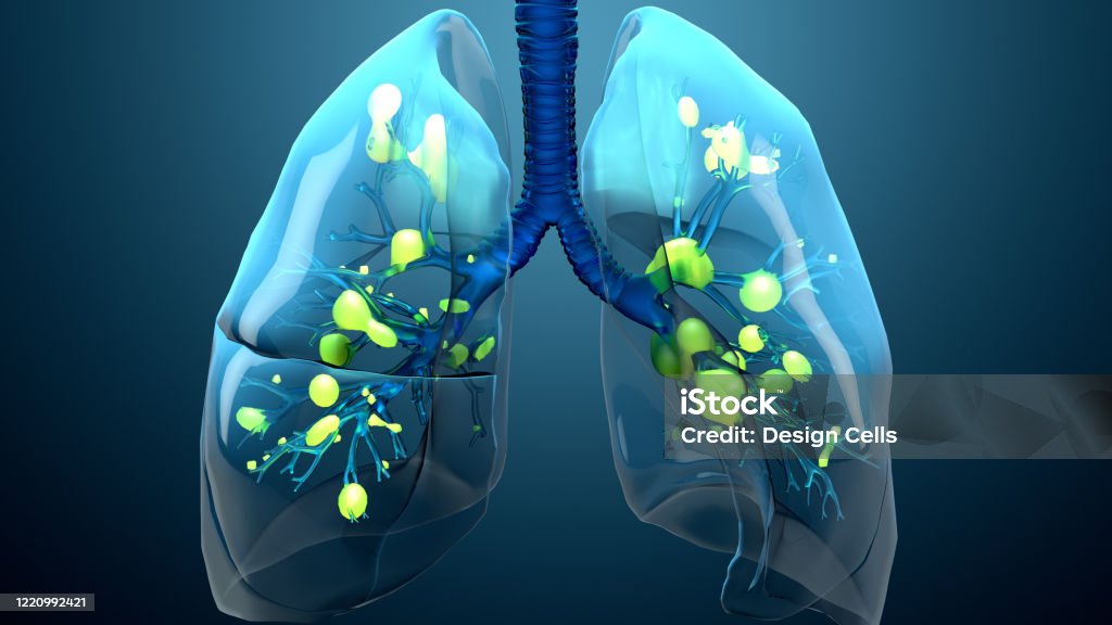Damage lungs, severe respiratory illness, pneumonia, ARDS, acute respiratory distress syndrome caused by the coronavirus Respiratory Disease Stock Photo