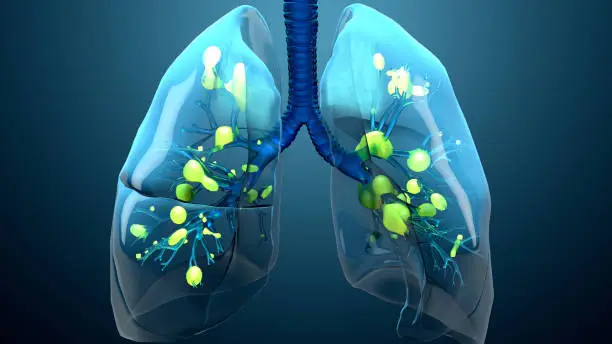 Photo of Damage lungs, severe respiratory illness, pneumonia, ARDS, acute respiratory distress syndrome caused by the coronavirus