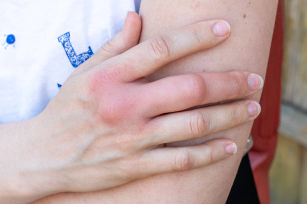 a woman with a swelling finger a right hand after a bee, wasp bite, swollen hand lyes on a right arm stinging stock pictures, royalty-free photos & images