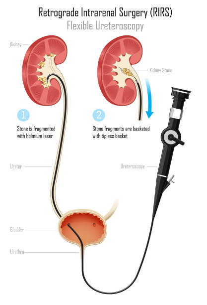 Retrograde Intrarenal Surgery, RIRS kidney stone treatment with flexible Ureteroscope ureter stock illustrations