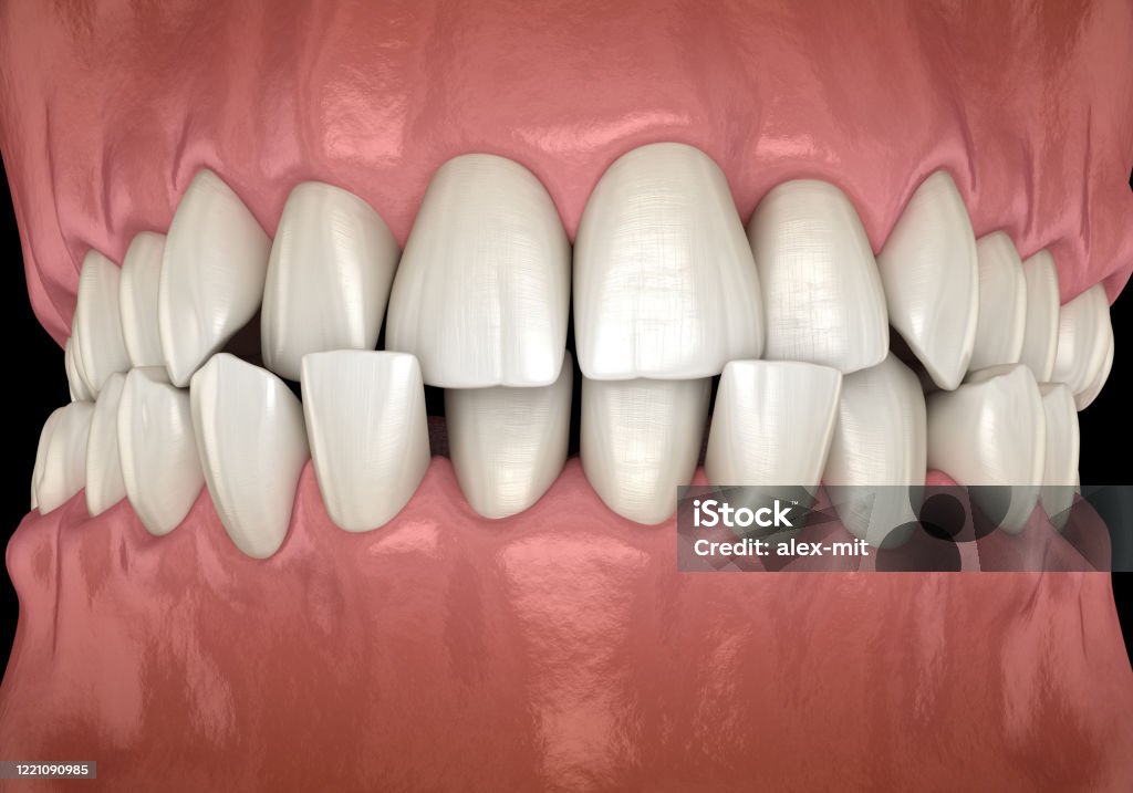 Anterior Crossbite Zahnverschluss ( Maloklusion der Zähne ). Medizinisch genaue Zahn-3D-Illustration - Lizenzfrei Zahn Stock-Foto